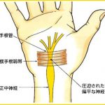 carpal_tunnel_syndrome_02